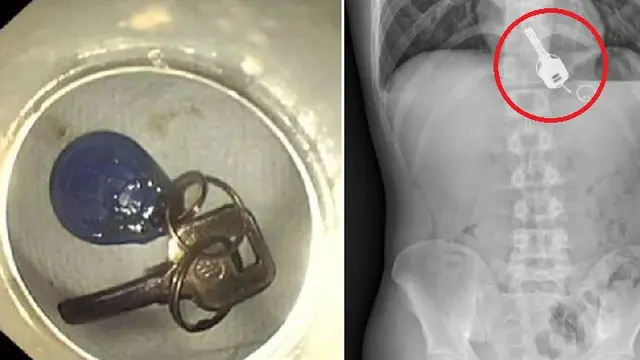 Mengaku Kehilangan Kunci, Pria Ini Ternyata Tak Sengaja Menelannya Saat Mabuk