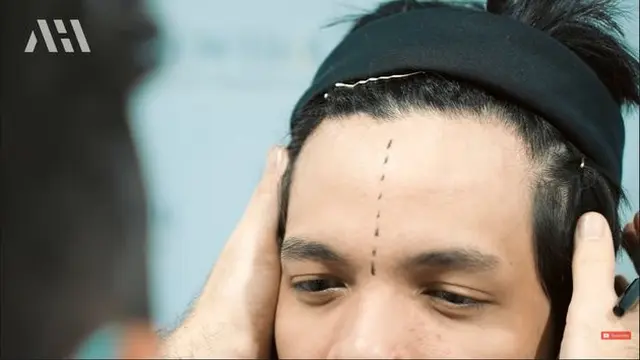 Akui Tak Percaya Diri, Ini 7 Potret Atta Halilintar Jalani Transplantasi Rambut