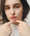 Berbeda dengan jerawat biasa, jerawat hormonal cenderung muncul berulang dan membutuhkan pendekatan perawatan yang konsisten. (Foto/Dok: Pexels)