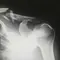 Hari Osteoporosis Sedunia: Kenali Pilihan Pengobatan dan Risiko Efek Sampingnya