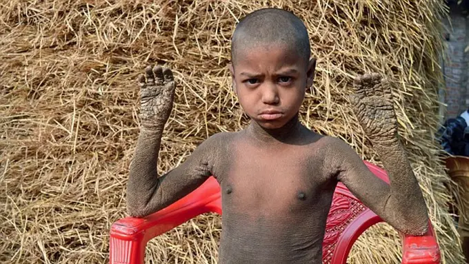 Sakit, Tubuh Bocah Ini Berubah Jadi Batu