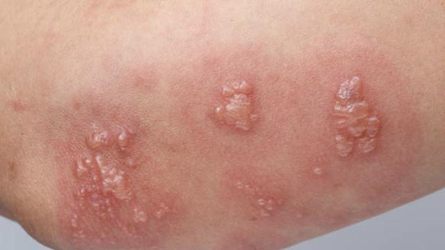 Penetapan mpox sebagai Situasi Darurat Global oleh WHO