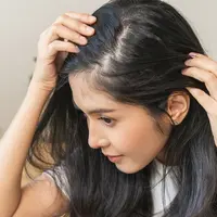Muncul bintik kebotakan. (c) Shutterstock/Kmpzzz