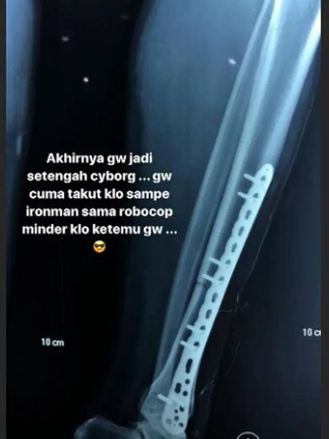 Sammy Simorangkir Patah Tulang Usai Kecelakaan, Ini 6 Potret Terbarunya