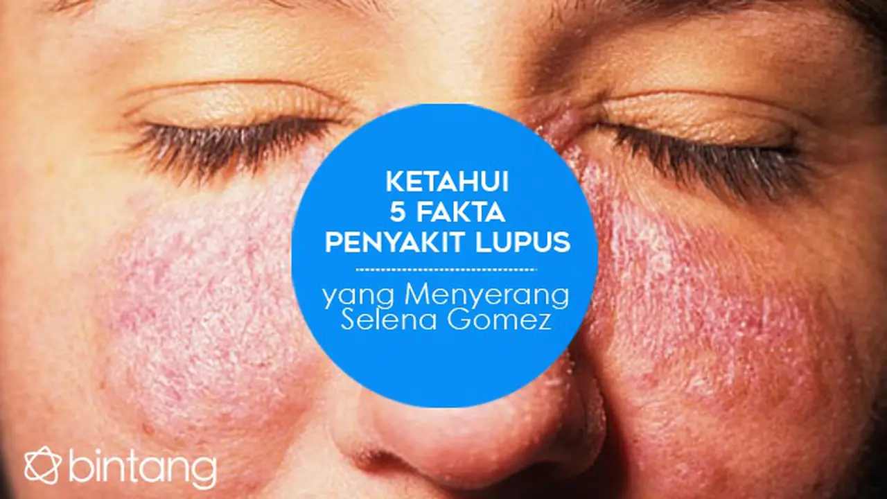 [Bintang] Ketahui 5 Fakta Penyakit Lupus yang Menyerang Selena Gomez
