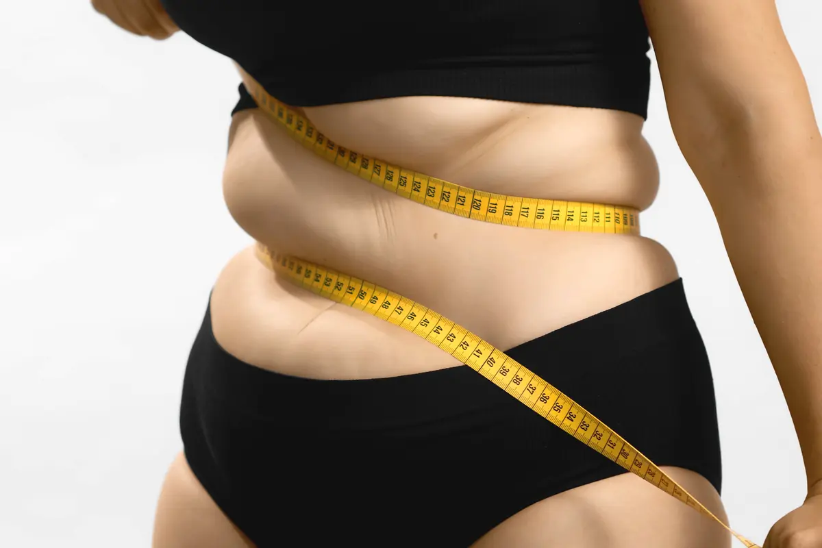 Lipoedema sering dianggap sebagai obesitas padahal keduanya berbeda