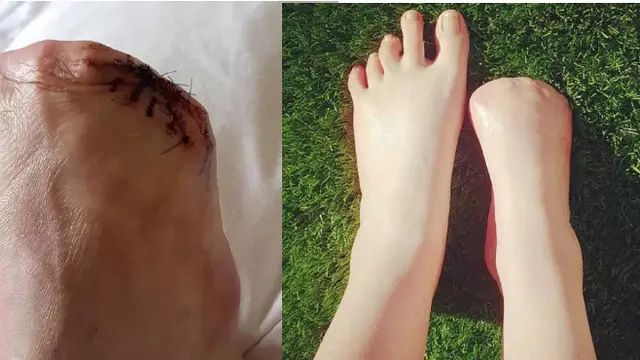 Jari Kaki Wanita ini Diamputasi Setelah Terinfeksi Bakteri dari Spa Ikan