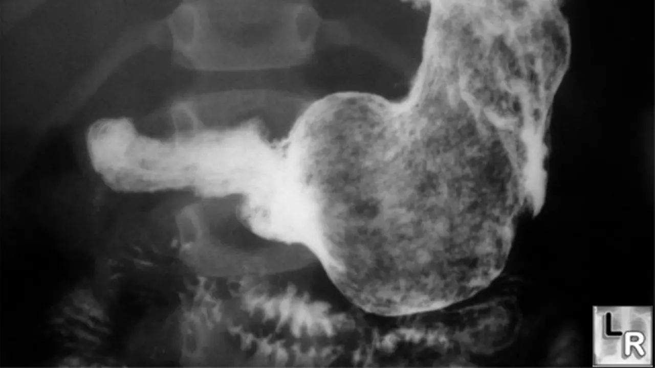 Rapunzel syndrome (0)