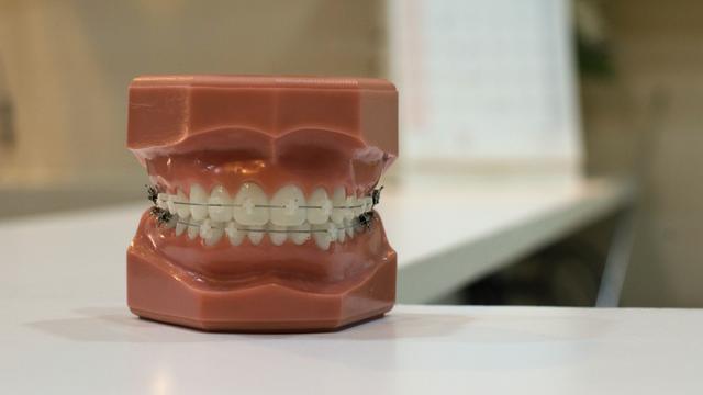 Ilustrasi bracket kawat gigi, behel