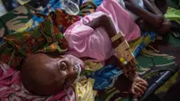 Seorang anak Papua yang menderita kekurangan gizi terbaring di tempat tidur rumah sakit untuk mendapat perawatan di Agats, Asmat, provinsi Papua Barat (26/1). (AFP/Bay Ismoyo)