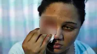 Gadis Hematidrosis, Air Mata dan Keringatnya Keluarkan Darah