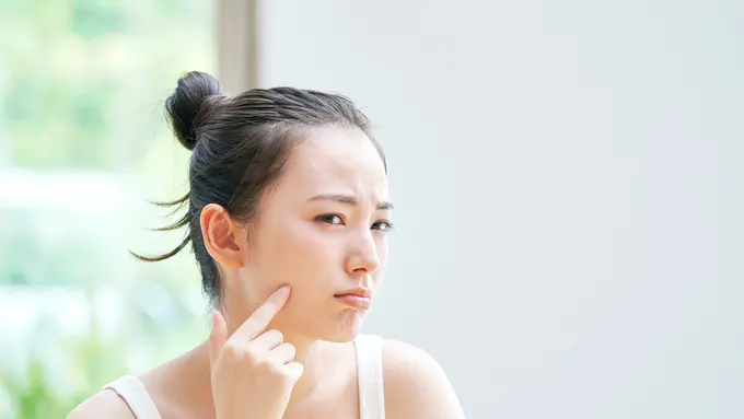 ilustrasi jerawat/siro46/shutterstock