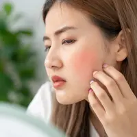 Ilustrasi kulit wajah kemerahan. (c) shisuka/Depositphotos.com