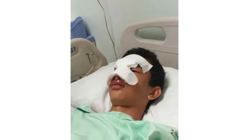 Korban perundungan pelajar di Pekanbaru ketika dirawat intensif karena mengalami patah tulang hidung.