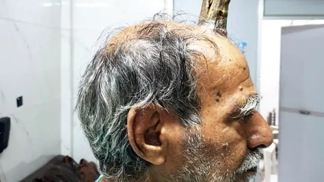 kakek di India miliki tanduk