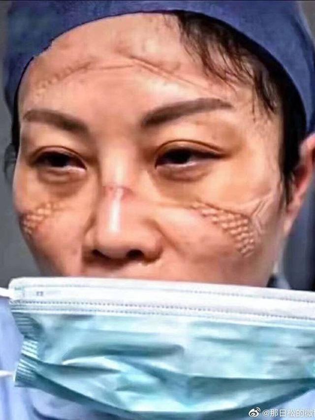 7 Potret Luka Lebam di Wajah Tim Medis Akibat Kacamata Pelindung Selama Perangi Virus Corona