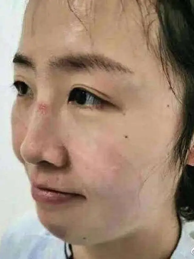 7 Potret Luka Lebam di Wajah Tim Medis Akibat Kacamata Pelindung Selama Perangi Virus Corona