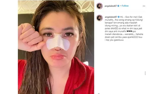 8 Selebriti Indonesia yang Lakukan Opersi Hidung, Terbaru Angela Lee