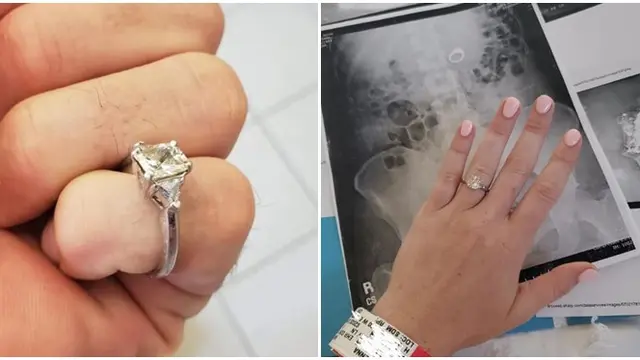 Dilamar Saat Tidur, Wanita Ini Malah Telan Cincin Tunangannya