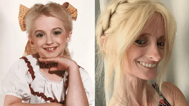 progeria