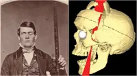 Insiden Kepala Tertembus Batangan Logam Kuak Misteri Dunia Medis