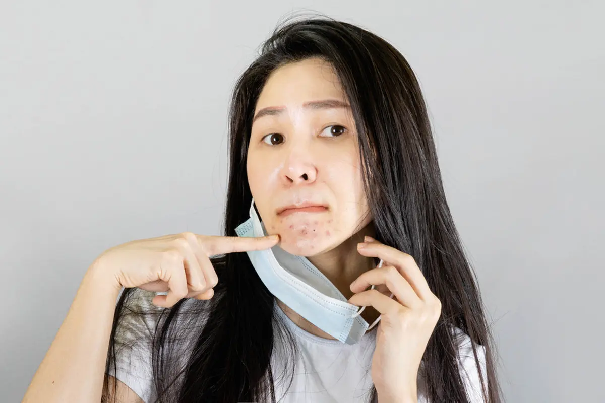 ilustrasi Facial Wash yang Cocok untuk Mencegah dan Menghilangkan Jerawat
