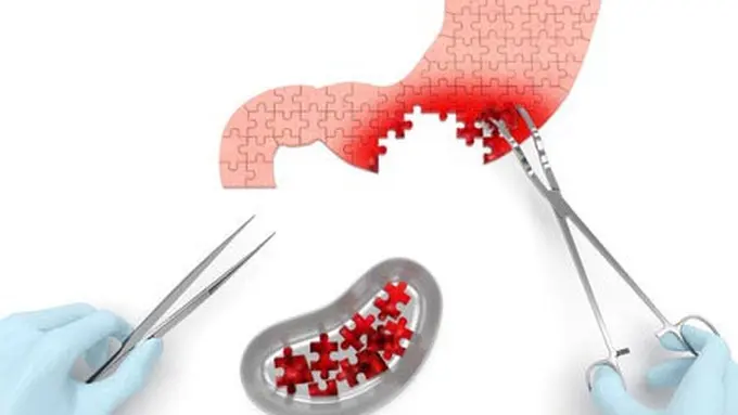 5 Penyakit Lambung yang Harus Kamu Waspadai