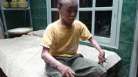 Ari Wibowo, remaja asal Tangerang ini memiliki penyakit sindrom manusia merah yang menyebabkan kulit di seluruh tubuhnya seperti bersisik dan kemudian mengelupas. (Liputan6.com/Benedikta Desideria)