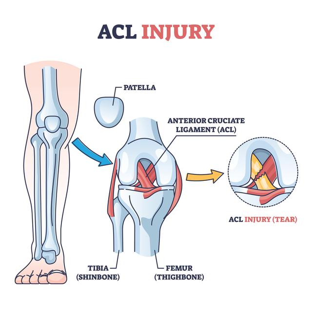 Ilustrasi cedera ACL