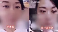 Operasi kelopak mata gandanya gagal, wanita ini diceraikan suami. (Sumber: NetEase)