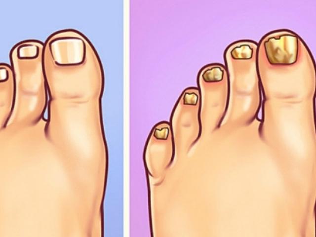 Jangan Anggap Sepele 5 Tanda Pada Kaki Bisa Ungkap Masalah Kesehatan Citizen6 Liputan6 Com