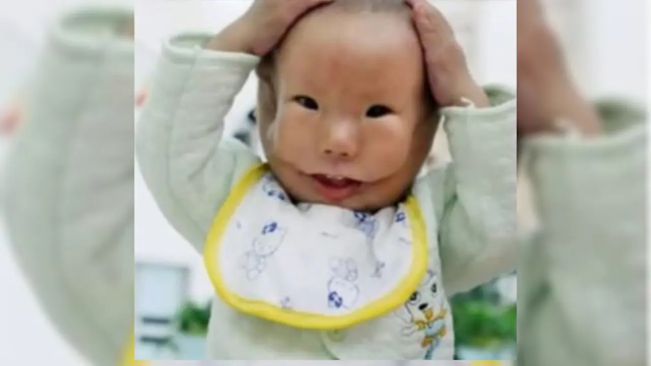 Kisah Bayi Malang yang Lahir Bak Punya 2 Wajah