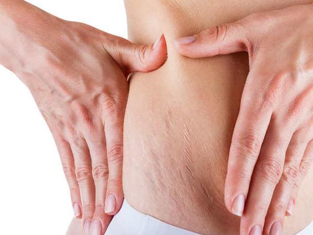 Selulit Dan Stretch Marks Apa Bedanya Health Liputan6 Com