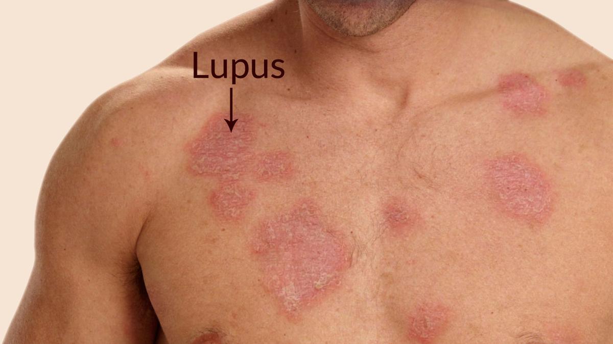 5 Hal Penting yang Harus Anda Ketahui tentang Penyakit Lupus: Menangkal Mitos dan Membangun Harapan