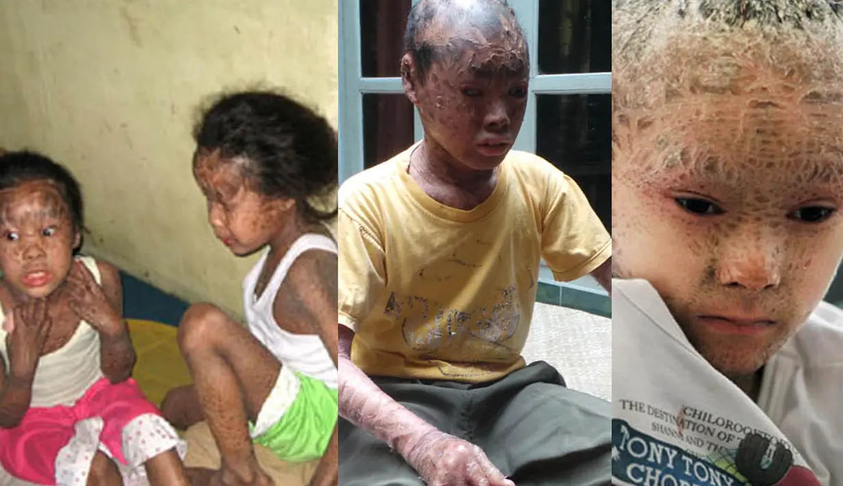 Ternyata kasus 'manusia bersisik' ditemukan di beberapa tempat. Berikut kasus beberapa orang yang memiliki kelainan kulit: (Istimewa) 