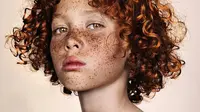 Freckles Muncul di Wajah Karena Alasan Ilmiah, Simak di Sini