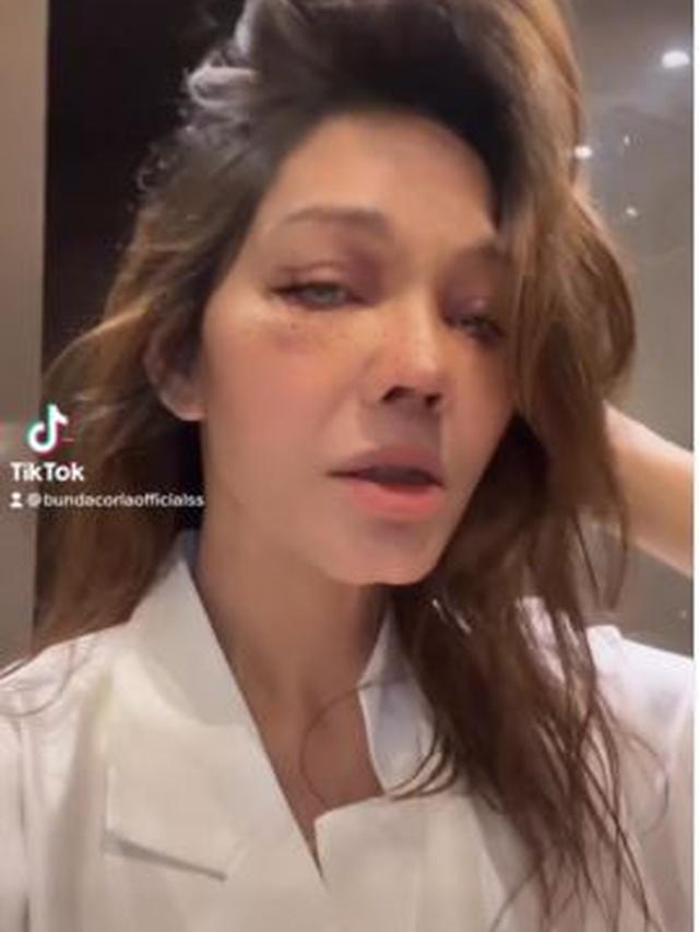 Bunda Corla Operasi Plastik, Ini 6 Potretnya dengan Perban dan Wajah Lebam