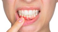 Radang Gusi - KlikDokter.com (Stefano Garau/Shutterstock)