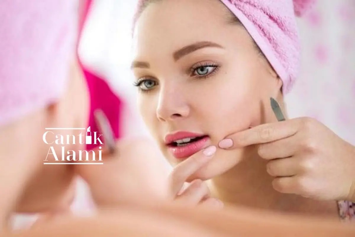 Cantik Alami: Jangan Dipencet, Pakai Racikan Ini Agar Jerawat Kempes
