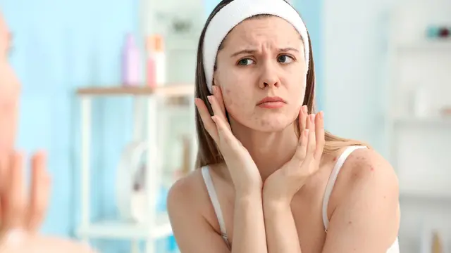 Cegah Jerawat Hormonal dengan Perawatan Wajah yang Tepat, Intip Rahasianya!