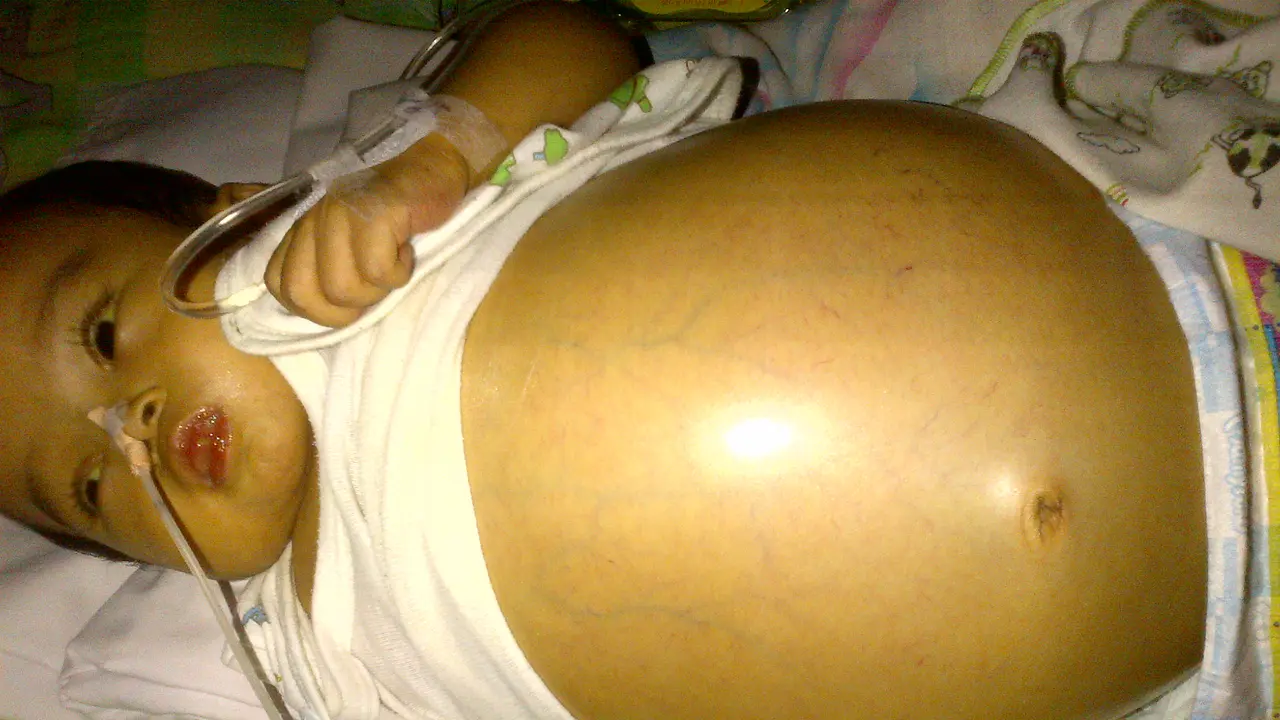 Bayi Abel Butuh Bantuan Dana untuk Transplantasi Hati