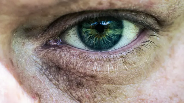 Kebiasaan hidup yang buruk dapat menimbulkan kerutan bawah mata