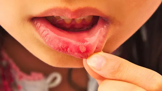 9 Penyebab Sariawan pada Anak