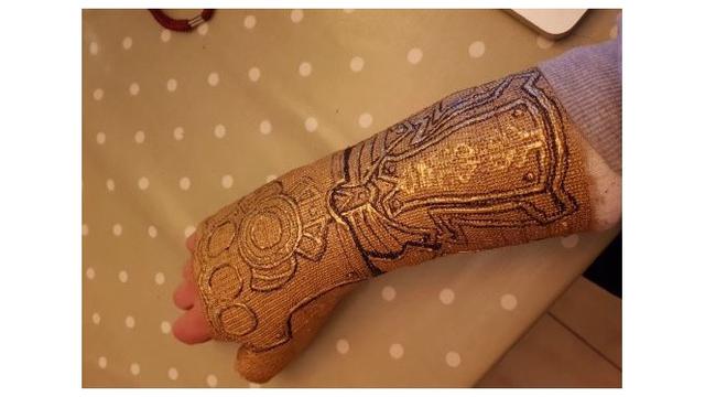 Pergelangan Tangannya Cedera, Pria Ini Gunakan Hiasan Gips yang Unik