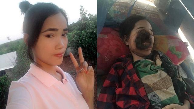 Dokter Ceroboh, Wajah Remaja Digerogoti Bakteri Pemakan Daging