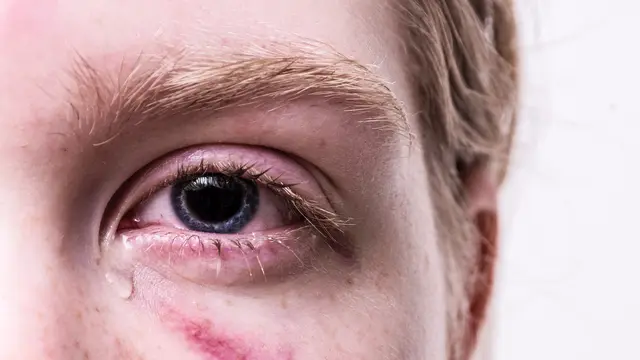 Cara Menghilangkan Memar di Tubuh