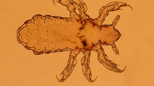 7 Arti Mimpi Kutu Rambut Menurut Primbon Jawa, Berkaitan dengan Rezeki