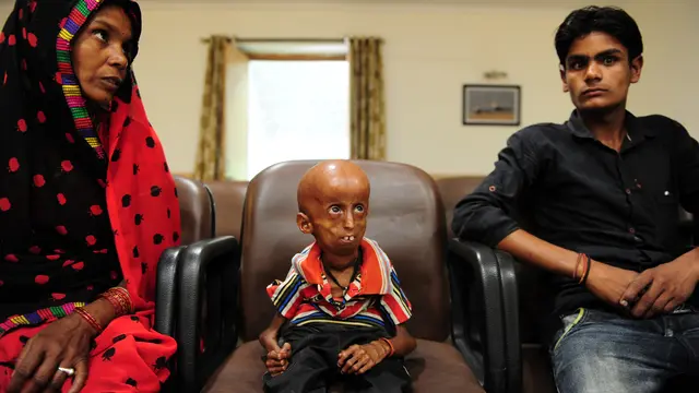 20170502-Rupesh, Pasien Progeria di India-AFP