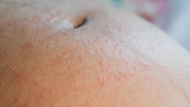 Ilustrasi ruam kulit