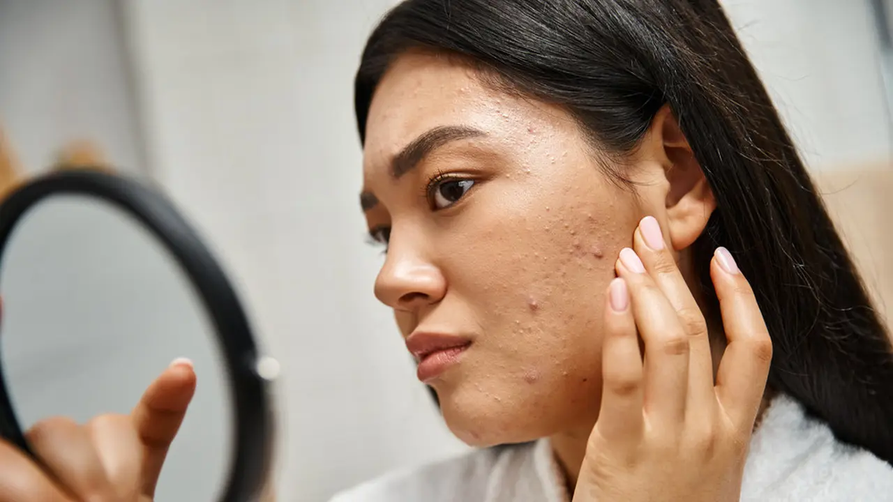 Treatment di Klinik Kecantikan Seperti Apa Sih yang Bisa Singkirkan Bekas Jerawat? Ini Jawabannya!